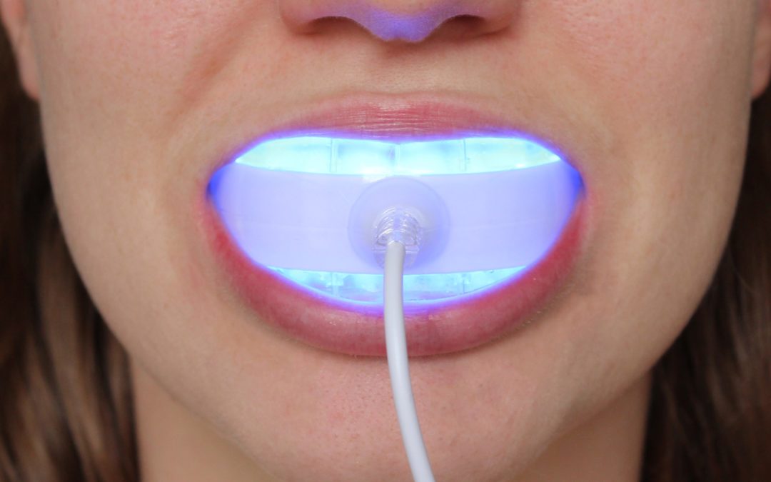 Led Lights Gimmick Or Game Changer, Best Teeth Whitening Light 2020